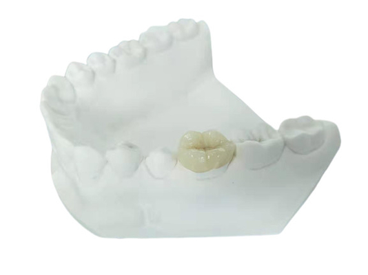 Onlay dental Todo-cerâmico durável do embutimento do folheado da coroa de FDA similar