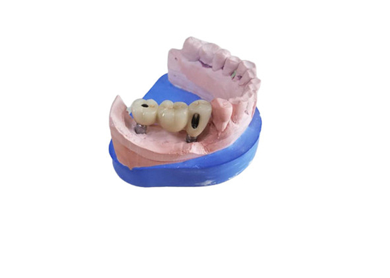 Coroa dental da zircônia do CAD CAM com o limite da zircônia da base do titânio