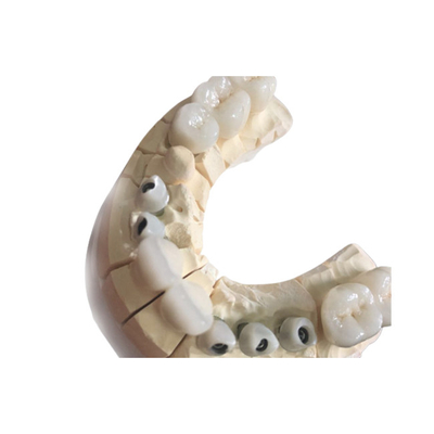 Coroas dentárias de zircônio personalizadas Excelente estética Material durável