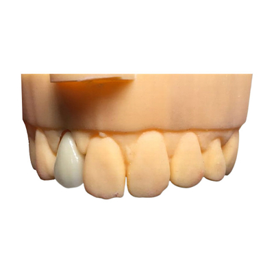 Ponte dental bom Biocompatibility da coroa da segurança PFM de Chromecast