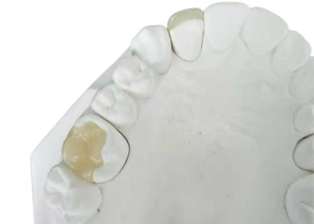 Coroa flexível durável IPS dental E Max Press Inlay Onlay da ponte de PFM