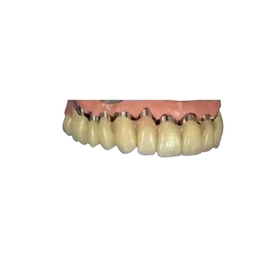 A coroa telescópica 3D dental da ponte da coroa do implante do CAD CAM PFM imprimiu modelos