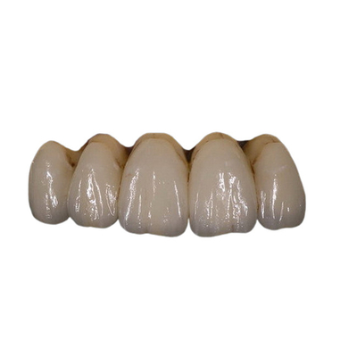 Fácil mantenha a estabilidade de cor dental da coroa da porcelana ortodôntica de PFM