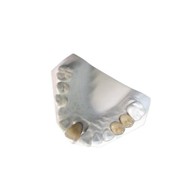 O dente natural da coroa dental cerâmica alta da estabilidade PFM mancha resistente