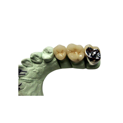 Porcelana alta da coroa de Biocompatibility PFM fundida para a restauração dos dentes traseiros