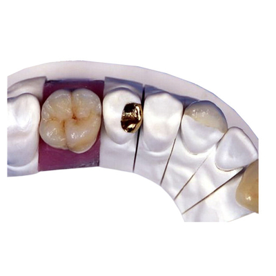 Coroa dental da porcelana de PFM