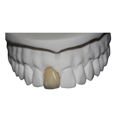 Coroa dental da porcelana do Cr do Co