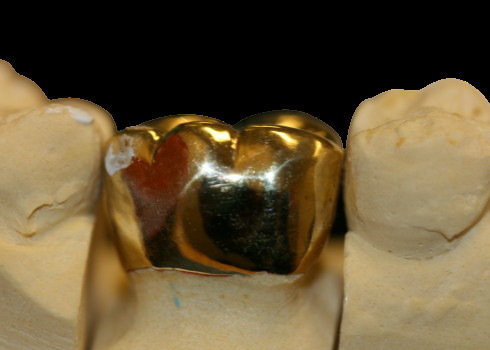 Da ponte fina da coroa da proteção FMC do alto densidade laboratório dental