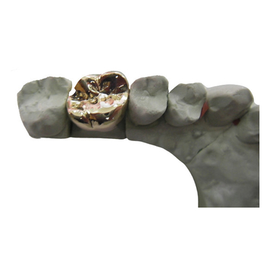 Elevação dental completa da ponte da coroa do metal PFM - material biológico da tecnologia