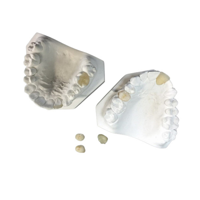 Fácil mantenha o Onlay dental cerâmico branco do embutimento do folheado da coroa do OEM