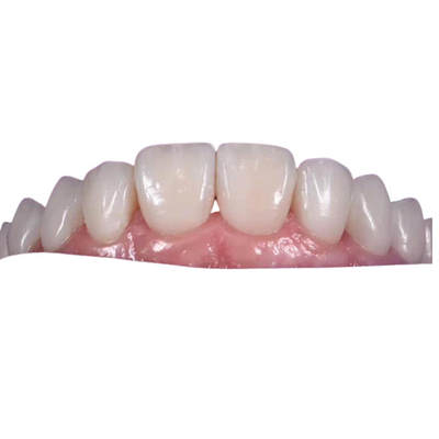 Coroa dental cerâmica clareando de 0.3MM para substituir os dentes insalubres