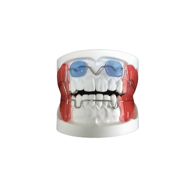 Boa fixação Anchorage adequado do dispositivo funcional dental fixo do dispositivo