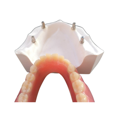 O implante dental confortável Overdenture do CAD CAM fácil mantém
