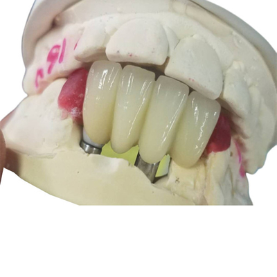 O si forte baseia o implante dental de trituração coroa a ponte apoiada dente