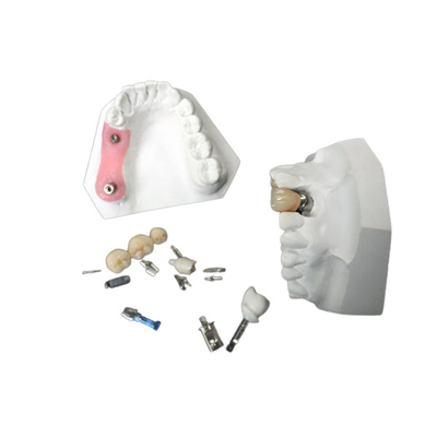 Coroa alta do implante dental da zircônia da durabilidade para a restauração dental