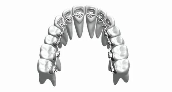 As cintas ortodônticas fixas dos dispositivos do costume endireitam os dentes Bioceramic de aço inoxidável