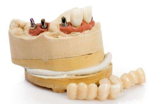 Implante dental personalizado do titânio durável da substituição do implante dental