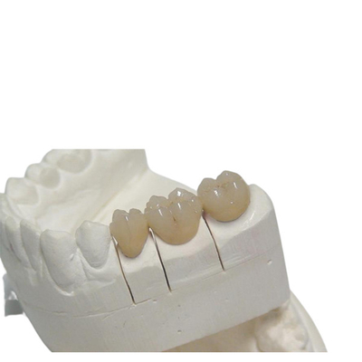 Coroa dental provisória 3D do CAD/CAM PFM que imprime a personalização da dentadura do projeto