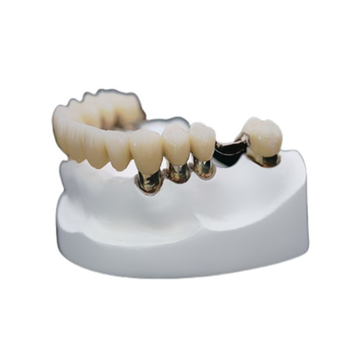 Da dentadura telescópica dental do acessório da precisão da coroa da resistência de corrosão estabilidade forte