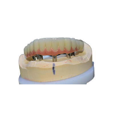 Coroa de limpeza fácil do implante dental confortável nenhuma sensação do corpo estrangeiro