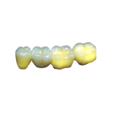 Vista - a alergia estética de grande resistência da coroa dental resistente de PFM amigável