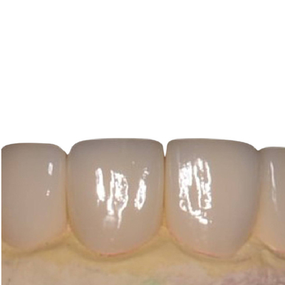 Os dentes lisos da porcelana não folheiam nenhum folheado branco bonito da porcelana da irritação