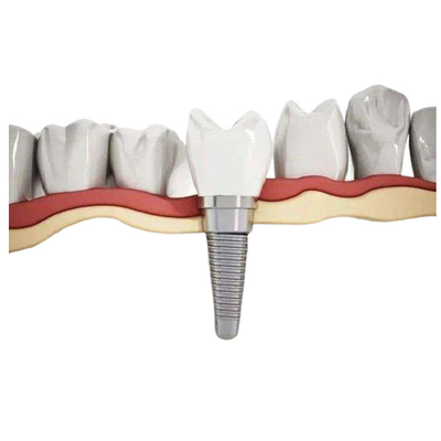 Implante dental Biocompatibility alto do titânio durável resistente à corrosão