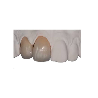Da coroa fina da zircônia da força do corpo restauração realística natural durável