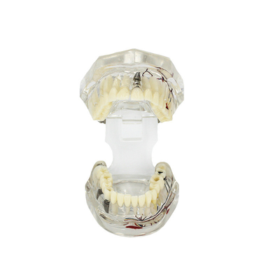 Modelo de dente patológico transparente com personalização do nervo do dente