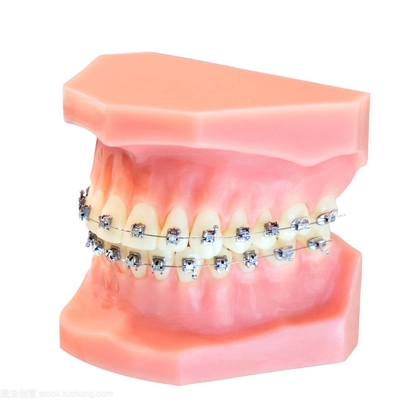 Aparelhos dentários, aparelhos ortodônticos fixos, upgrade de braquetes de arame macio