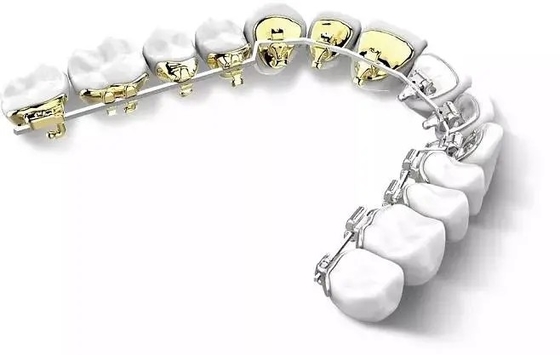 Aparelhos Dentários Aparelhos Ortodônticos Fixos Lado Posterior Aparelho Invisível Lingual Estético Natural