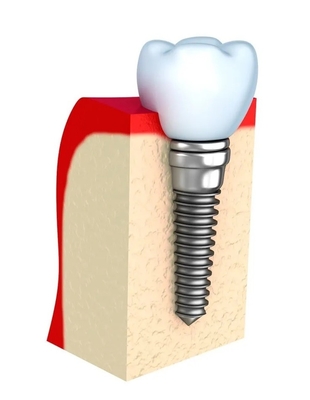 Dentaduras provisórias barra de implante dentário único todos os dentes de cerâmica
