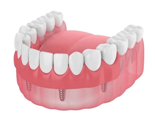 Dentaduras Dentes Perdidos Implantes Dentários Restaurações de Barras Dentaduras Dentaduras Removíveis Temporárias