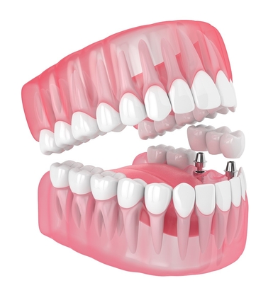 Implantes dentários únicos, todos de cerâmica, próteses de preenchimento ausentes, dentes do siso