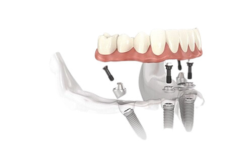 Dentaduras Removíveis Invisíveis Implantes Preenchidos Restauração Completa Overdenture