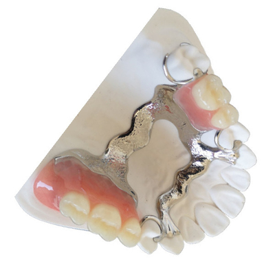 Coroa personalizada 3D do dente de PFM que imprime a ponte dental de PFM