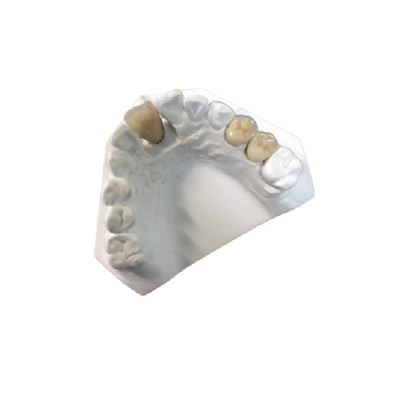 Condição nova de grande resistência do OEM da coroa dental da porcelana do ouro amarelo