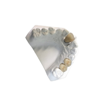 Do laboratório dental PFM da coroa da porcelana do ouro amarelo coroa cerâmica de grande resistência