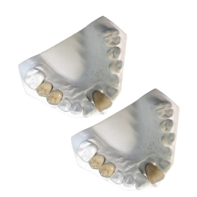 O bom metal mecânico da porcelana coroa o ouro amarelo de grande resistência