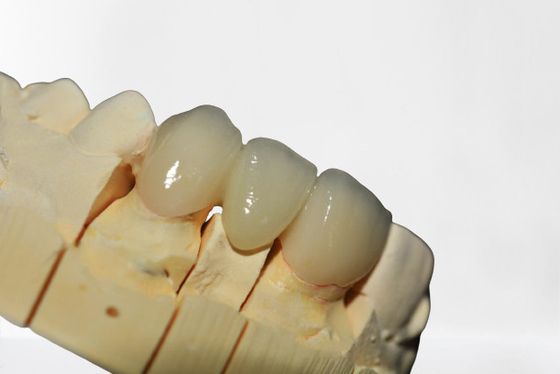 A ponte dental bonita da coroa veste a restauração natural que mastiga o poder