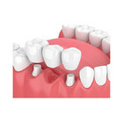 A resistência de desgaste forte dental confortável das coroas e das pontes faz o sorriso mais doce