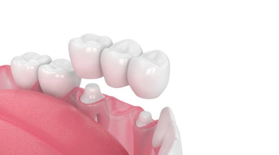 Força da mordida da estabilidade da aparência realística dental de grande resistência da ponte da coroa boa