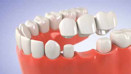 Força da mordida da estabilidade da aparência realística dental de grande resistência da ponte da coroa boa