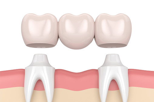 Revestimento alto alto da resistência de desgaste da coroa do dente da porcelana da segurança da higiene oral