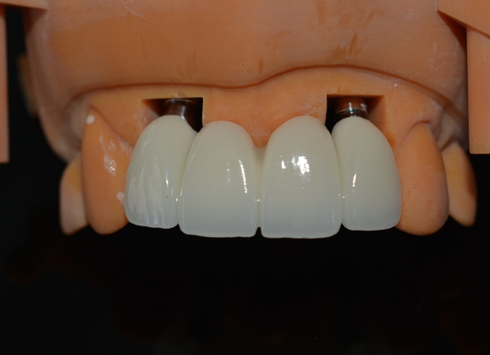 Design CAD/CAM preciso de coroa dental de zircônio para ajuste