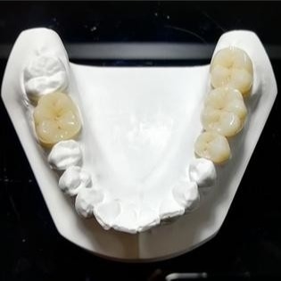 Qualidade inquebrável as coroas de Mark Of Our Ceramic Dental