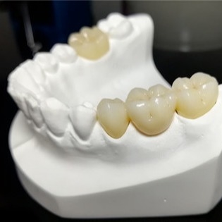 Qualidade inquebrável as coroas de Mark Of Our Ceramic Dental