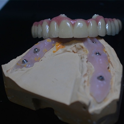 A personalização apta perfeita em nossas coroas do implante dental