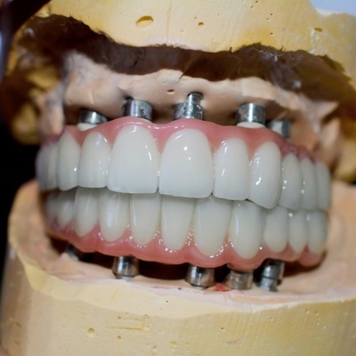 A viagem a um sorriso saudável nosso processo da coroa do implante dental