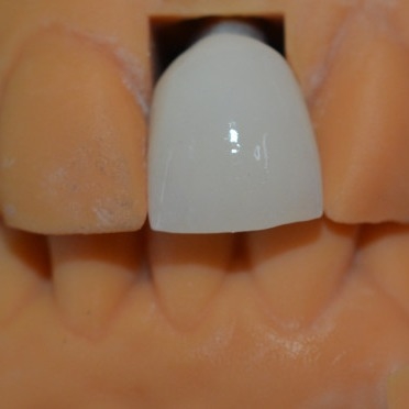 A força atrás de nosso sucesso nossos técnicos da coroa do implante dental